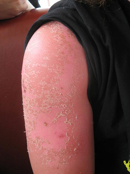 starker Sonnenbrand
